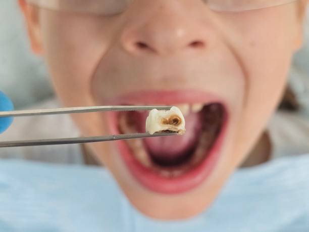 Best Emergency Dental Care for Broken or Chipped Teeth in Rensselaer, IN